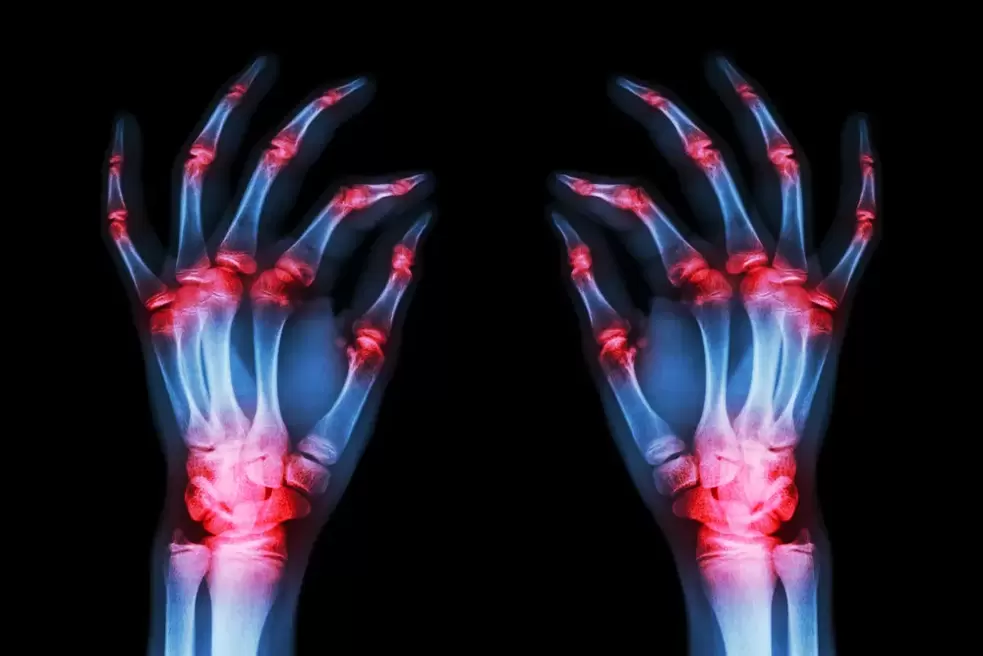 osteoarthritis of the finger joints