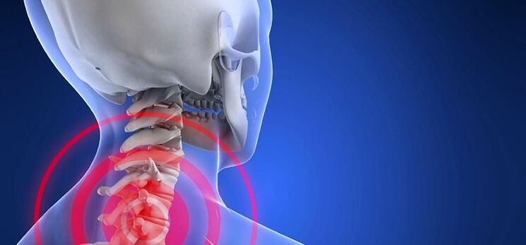Osteochondrosis of the cervical region