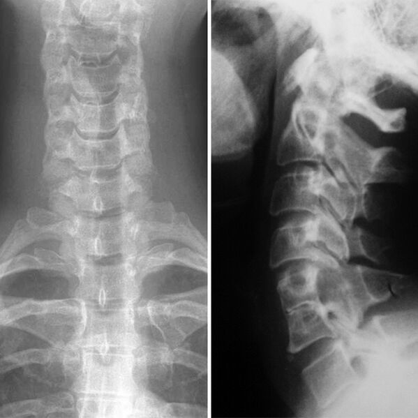 X-ray of the cervical column