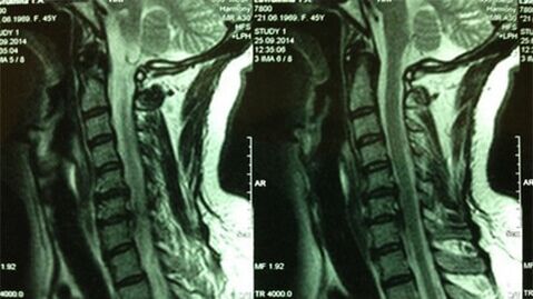 IRM of the Cervical Service