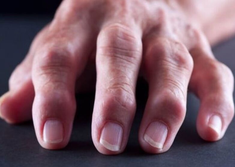 Rheumatoid arthritis as the cause of pain in the joints of the fingers