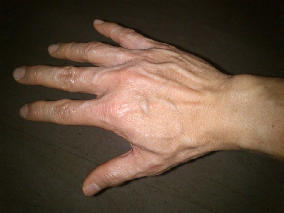 bone deformity and pain in the joints of the fingers