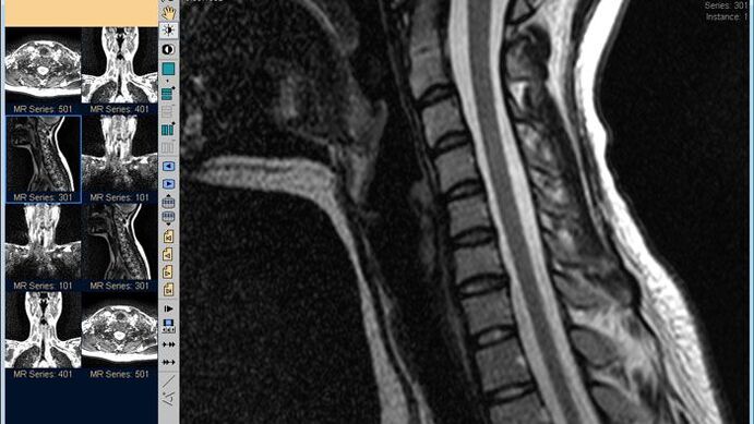 MRI of the cervical spine is the best method to diagnose neck pain
